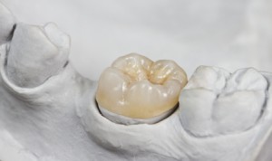 dental onlay on a cast model